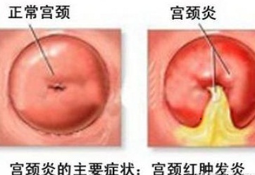 宫颈炎
