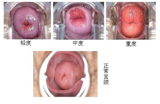 宫颈糜烂