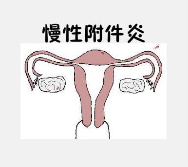 附件炎