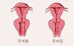 阴道紧缩