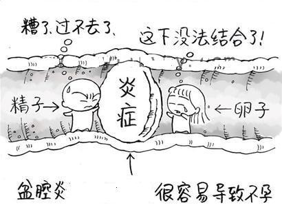 盆腔炎