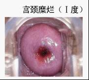 宫颈糜烂1度