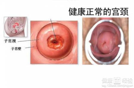 宫颈肥大