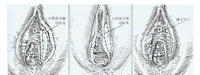 阴唇整形