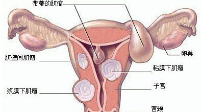 子宫肌瘤