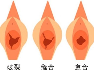 处女膜修复