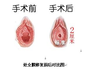 处女膜修复
