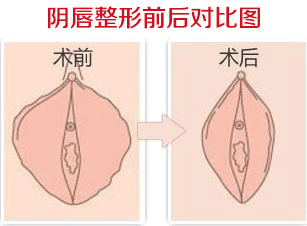 阴唇整形