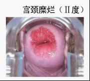 宫颈糜烂中度