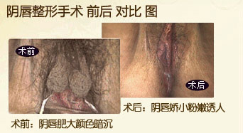 阴唇整形