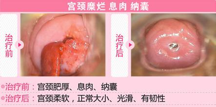 宫颈糜烂